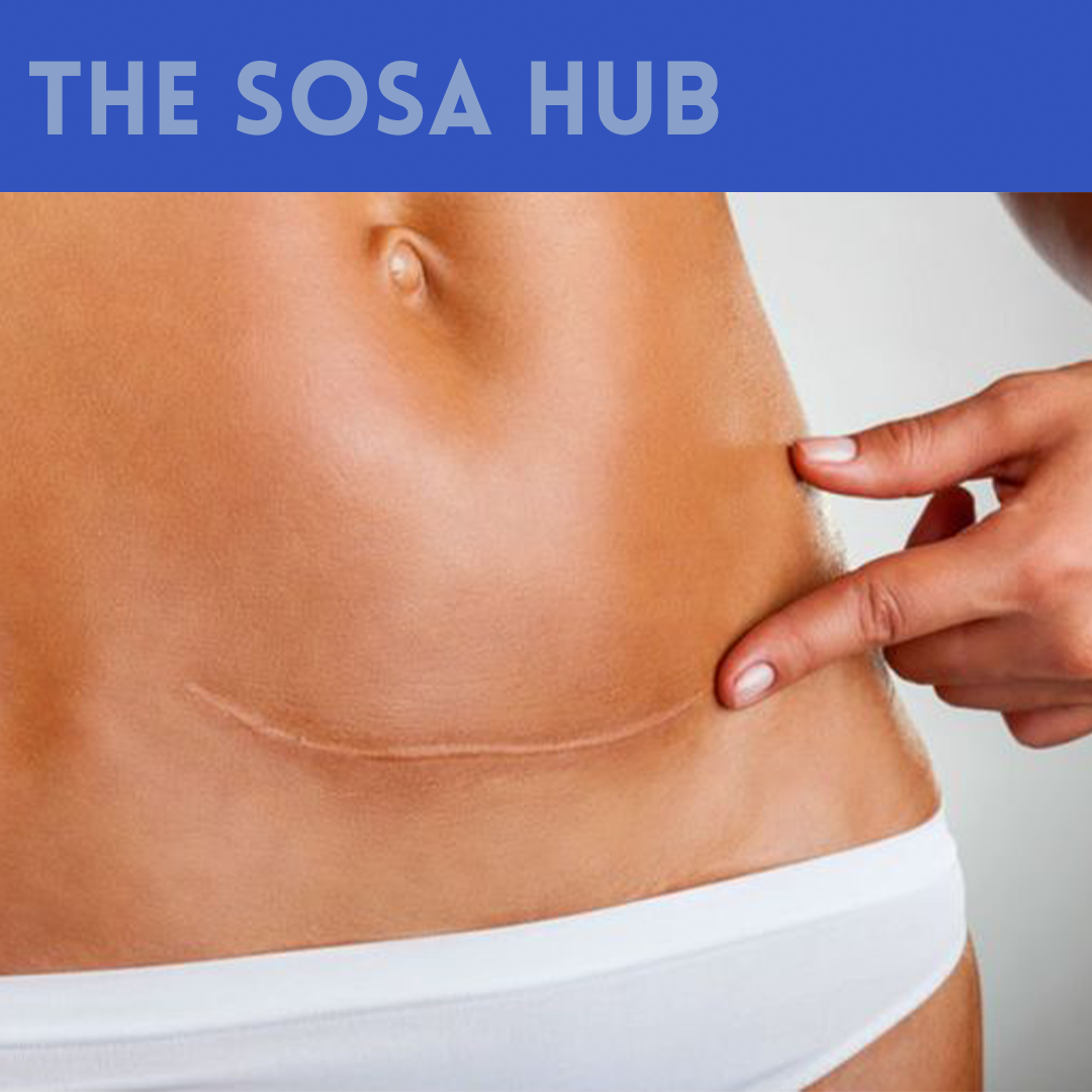 How to Deal With Gastric Sleeve Scars - The Sosa Clinic