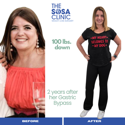 Bariatric Surgery Before and After Image TheSosaClinic.com Dr, Jorge Luis Sosa
