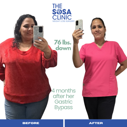 Bariatric Surgery Before and After Image TheSosaClinic.com Dr, Jorge Luis Sosa