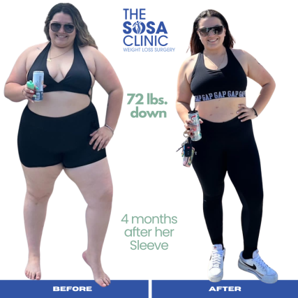 Bariatric Surgery Before and After Image TheSosaClinic.com Dr, Jorge Luis Sosa