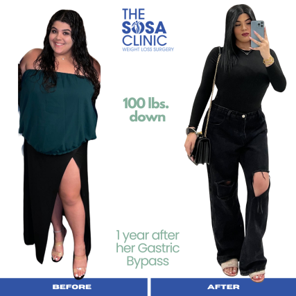 Bariatric Surgery Before and After Image TheSosaClinic.com Dr, Jorge Luis Sosa