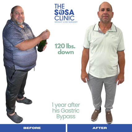 Bariatric Surgery Before and After Image TheSosaClinic.com Dr, Jorge Luis Sosa