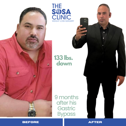 Bariatric Surgery Before and After Image TheSosaClinic.com Dr, Jorge Luis Sosa