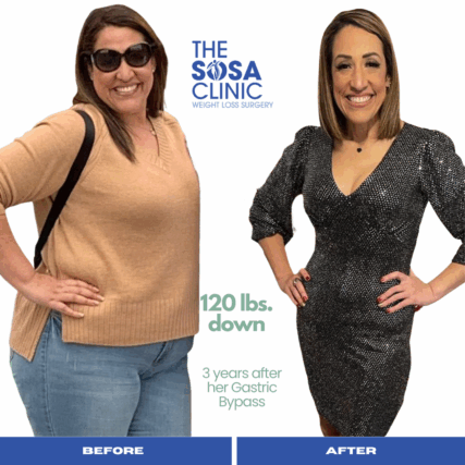 Bariatric Surgery Before and After Image TheSosaClinic.com Dr, Jorge Luis Sosa