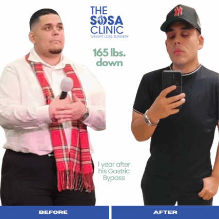Bariatric Surgery Before and After Image TheSosaClinic.com Dr, Jorge Luis Sosa