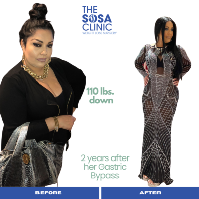 Bariatric Surgery Before and After Image TheSosaClinic.com Dr, Jorge Luis Sosa