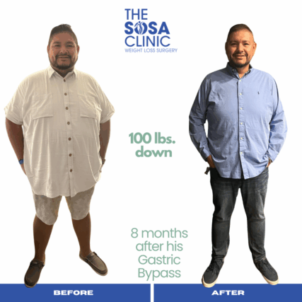 Bariatric Surgery Before and After Image TheSosaClinic.com Dr, Jorge Luis Sosa