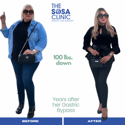 Bariatric Surgery Before and After Image TheSosaClinic.com Dr, Jorge Luis Sosa