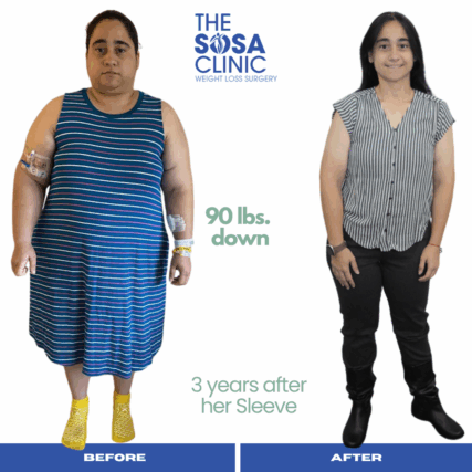 Bariatric Surgery Before and After Image TheSosaClinic.com Dr, Jorge Luis Sosa