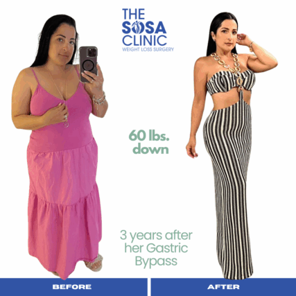 Bariatric Surgery Before and After Image TheSosaClinic.com Dr, Jorge Luis Sosa